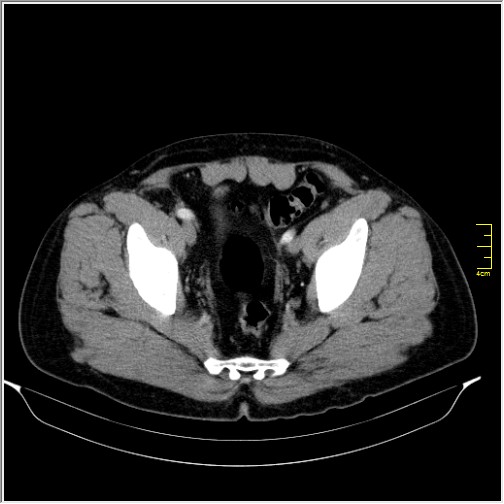 File:Acute right sided diverticulitis (Radiopaedia 65249-74268 Axial C+ portal venous phase 70).JPG