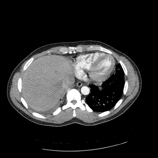 Acute segmental pulmonary emboli and pulmonary infarction (Radiopaedia 62264-70444 Axial C+ CTPA 91).jpg