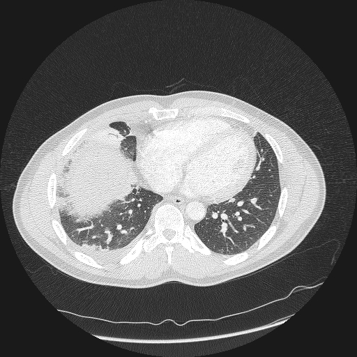Acute segmental pulmonary emboli and pulmonary infarction (Radiopaedia 62264-70444 Axial lung window 132).jpg