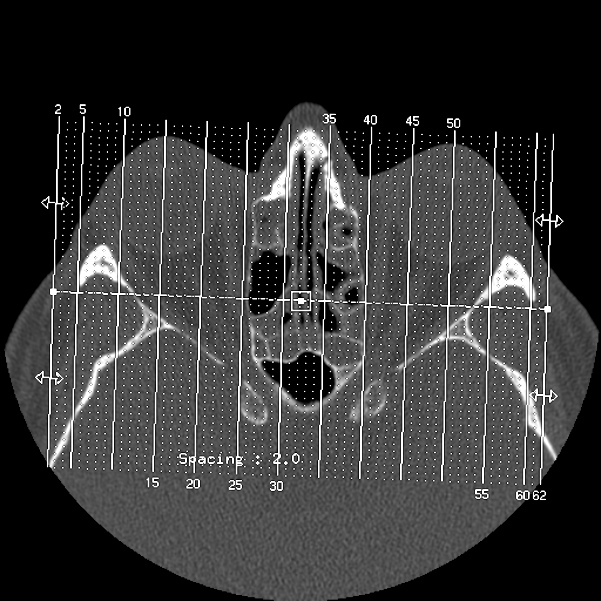 Acute sinusitis (Radiopaedia 23161-23215 Sagittal bone window 1).jpg
