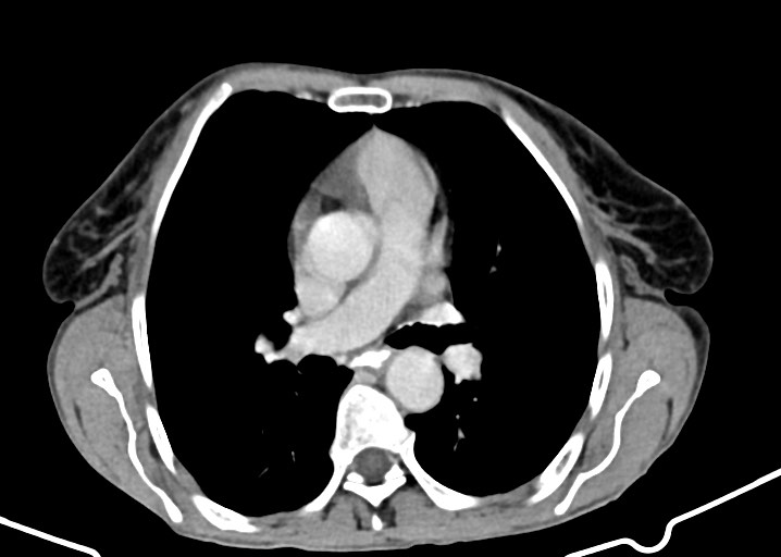Acute small bowel (ileal) volvulus (Radiopaedia 71740-82139 Axial C+ portal venous phase 8).jpg