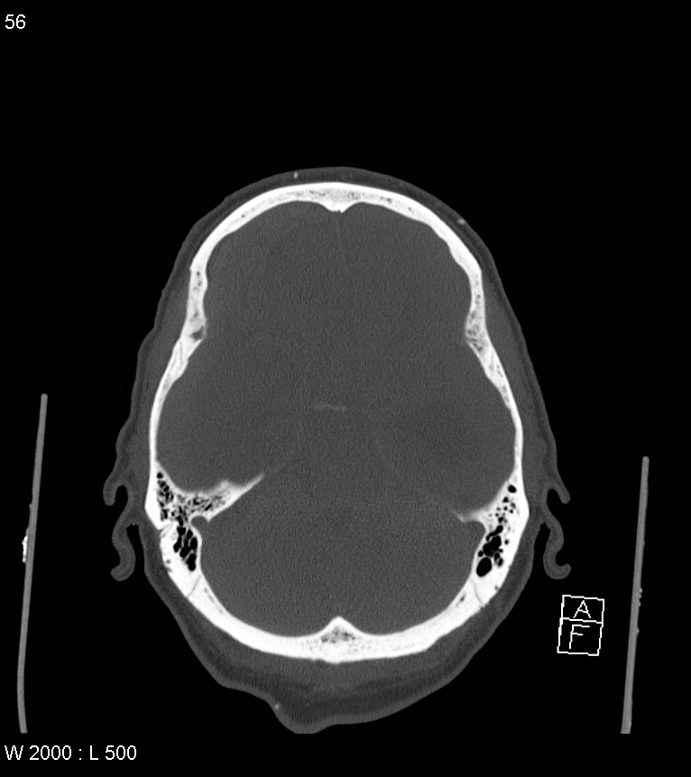 Acute subdural hematoma with myelofibrosis (Radiopaedia 52582-58494 Axial bone window 28).jpg