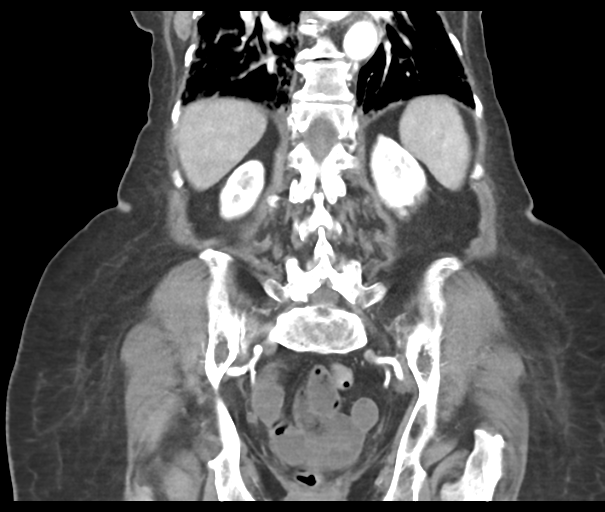 Acute superior mesenteric artery occlusion (Radiopaedia 43926-47418 Coronal C+ portal venous phase 36).png
