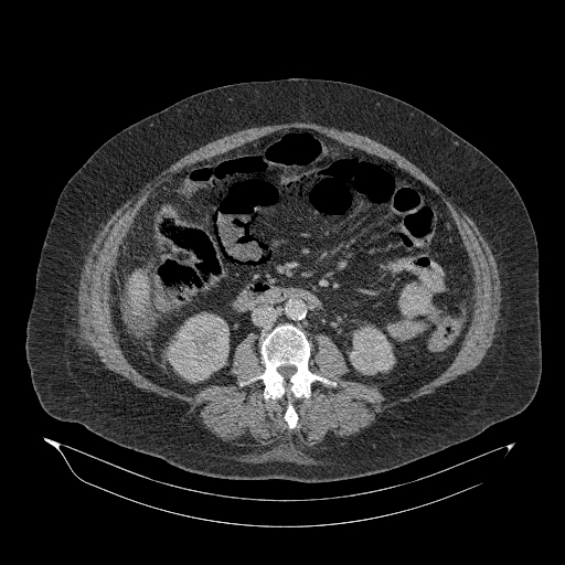 Acute superior mesenteric artery occlusion (Radiopaedia 51288-56960 Axial C+ portal venous phase 52).jpg