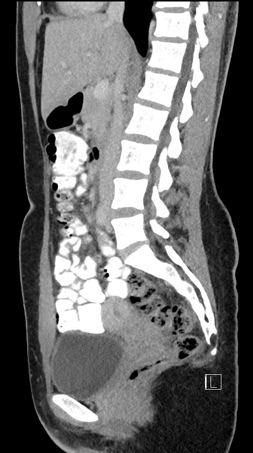 Acute uncomplicated appendicitis (Radiopaedia 61374-69304 Sagittal C+ portal venous phase 54).jpg