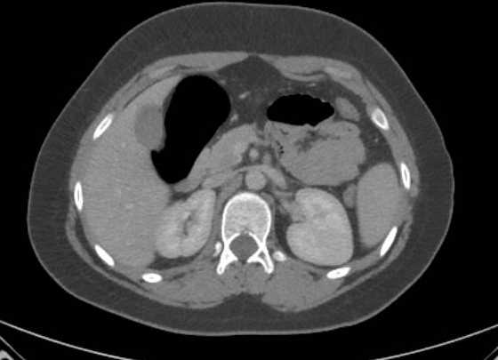 Acute unilateral nonhemorrhagic adrenal infarction (Radiopaedia 67560-76957 Axial renal parenchymal phase 53).jpg