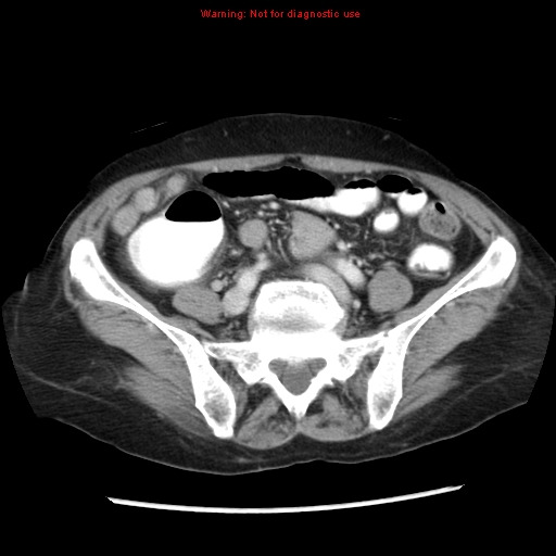Adenocarcinoma of the colon (Radiopaedia 8191-9039 Axial liver window 52).jpg