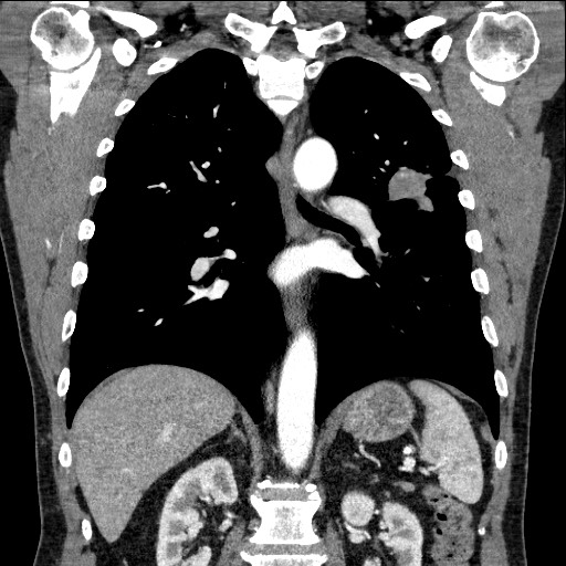 Adenocarcinoma of the lung (Radiopaedia 59871-67325 Coronal C+ arterial phase 43).jpg