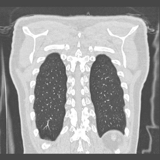 Adenocarcinoma of the lung (Radiopaedia 59871-67325 Coronal lung window 58).jpg