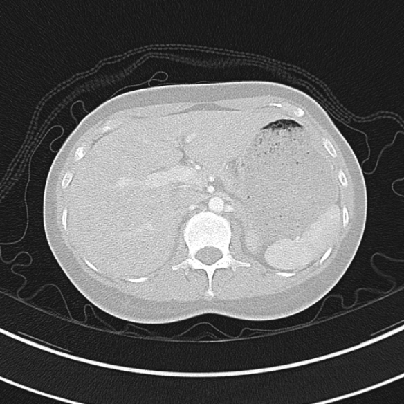 Adenocystic carcinoma of the trachea (Radiopaedia 47677-52525 Axial lung window 79).jpg