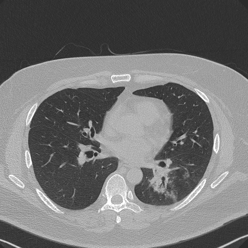 Adenoid cystic carcinoma of the trachea (Radiopaedia 49042-54137 Axial lung window 191).jpg