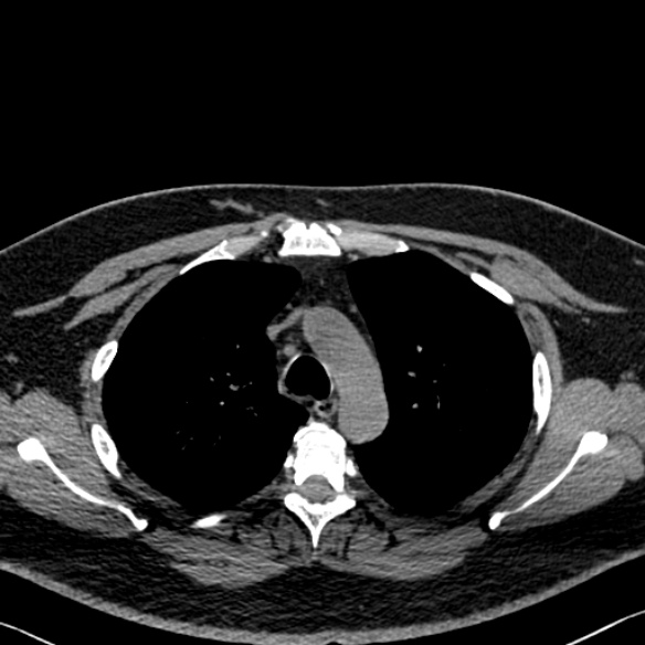 Adenoid cystic carcinoma of the trachea (Radiopaedia 49042-54137 Axial non-contrast 97).jpg