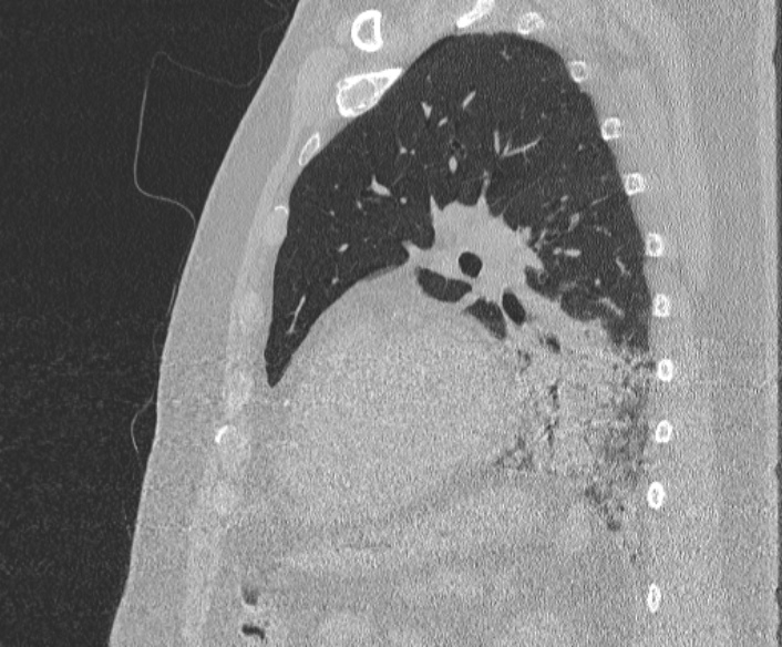 Adenoid cystic carcinoma of the trachea (Radiopaedia 49042-54137 Sagittal lung window 313).jpg