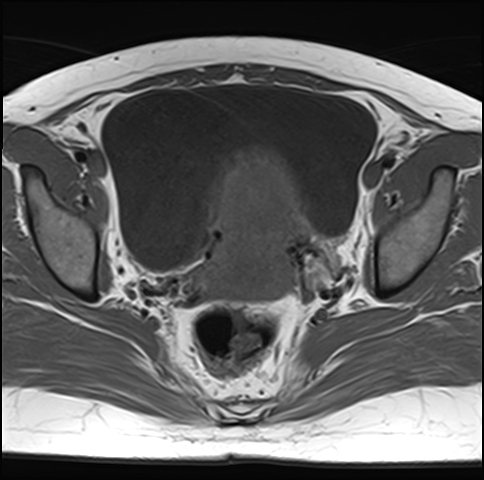 File:Adenomyosis - ovarian endometriomas (Radiopaedia 67031-76350 Axial T1 17).jpg