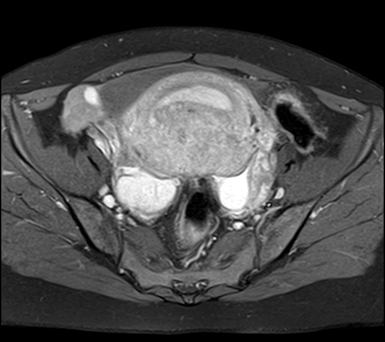 File:Adenomyosis - ovarian endometriomas (Radiopaedia 67031-76350 Axial T1 C+ fat sat 12).jpg