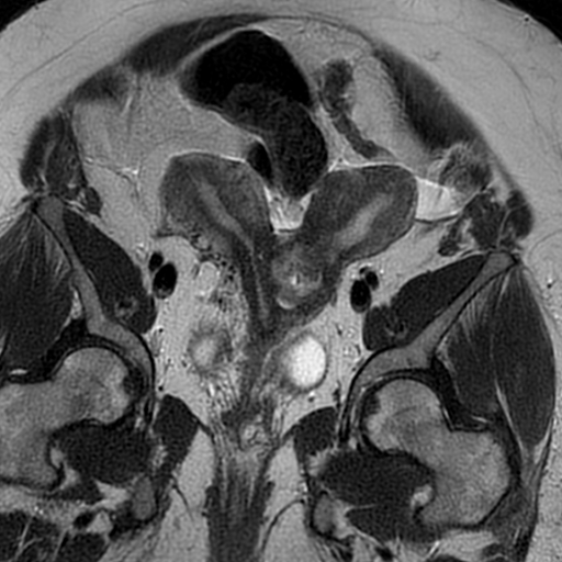 File:Adenomyosis within a didelphys uterus (Radiopaedia 70175-80215 Coronal T2 14).jpg