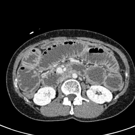Adhesional small bowel obstruction (Radiopaedia 48397-53305 Axial C+ portal venous phase 32).jpg