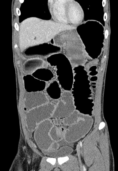 File:Adhesional small bowel obstruction (Radiopaedia 52107-57980 Coronal C+ portal venous phase 20).jpg