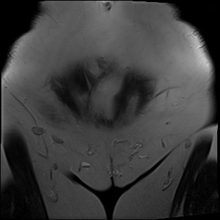 File:Adnexal multilocular cyst (O-RADS US 3- O-RADS MRI 3) (Radiopaedia 87426-103754 Coronal T2 2).jpg
