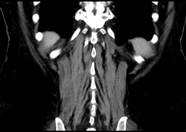 Adrenal cortical carcinoma (Radiopaedia 64017-72769 Coronal C+ portal venous phase 46).jpg
