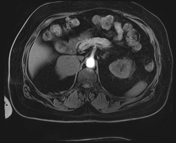 File:Adrenal cortical carcinoma (Radiopaedia 64017-72770 Axial T1 C+ fat sat 13).jpg