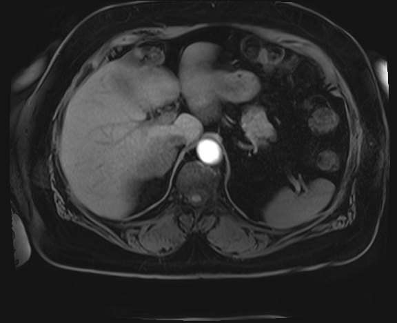 Adrenal cortical carcinoma (Radiopaedia 64017-72770 Axial T1 C+ fat sat 3).jpg