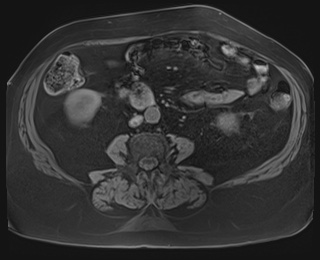 Adrenal cortical carcinoma (Radiopaedia 64017-72770 Axial T1 fat sat 60).jpg