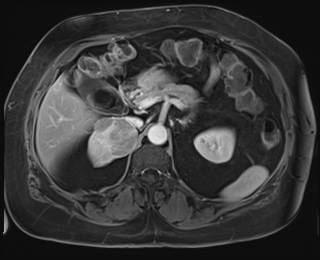 Adrenal cortical carcinoma (Radiopaedia 64017-72770 J 32).jpg