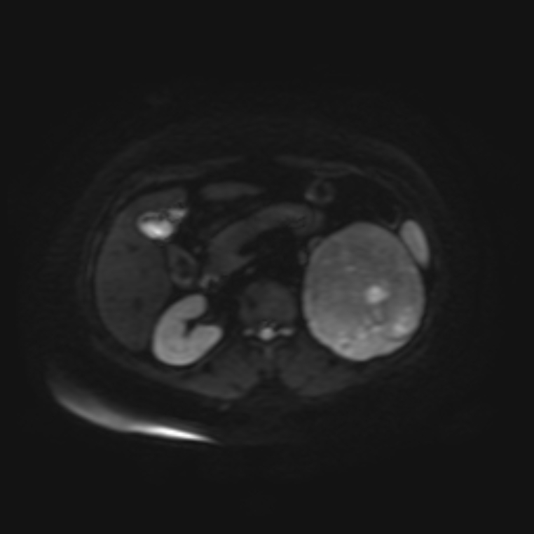 Adrenal cortical carcinoma (Radiopaedia 70906-81116 Axial DWI 13).jpg