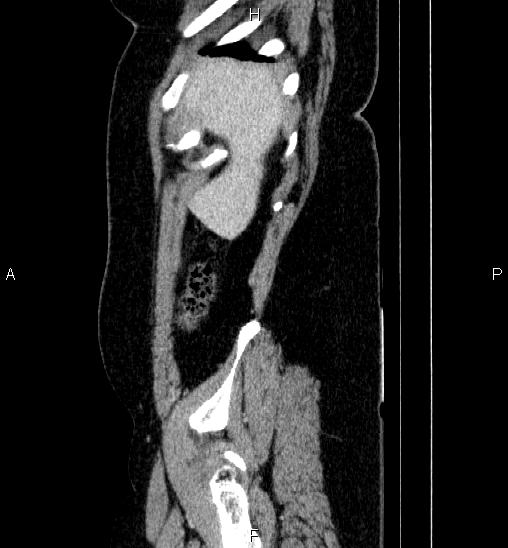 File:Adrenal cortical carcinoma (Radiopaedia 84882-100379 Sagittal C+ portal venous phase 10).jpg