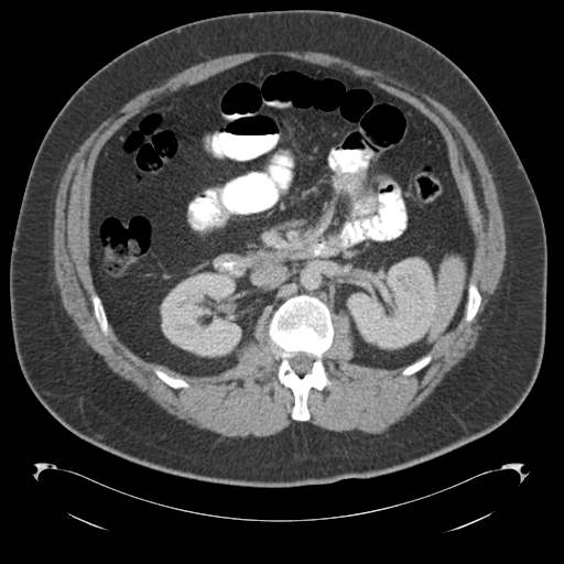Adrenal cyst (Radiopaedia 45625-49776 Axial C+ portal venous phase 41).png