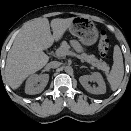 Adrenal gland trauma (Radiopaedia 81351-95079 Axial non-contrast 36).jpg
