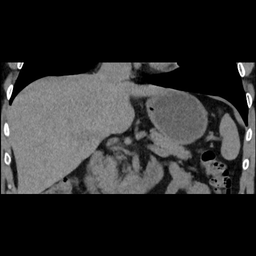Adrenal gland trauma (Radiopaedia 81351-95079 Coronal non-contrast 43).jpg