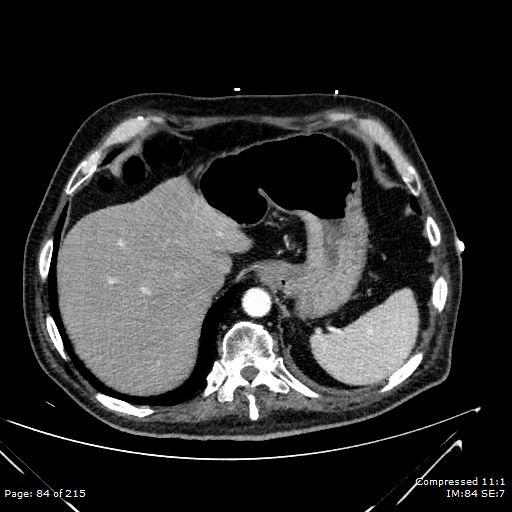 Adrenal metastasis (Radiopaedia 78425-91079 Axial C+ arterial phase 14).jpg
