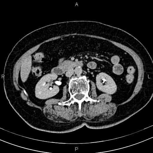 Adrenal myelolipoma (Radiopaedia 82742-96986 Axial renal excretory phase 70).jpg