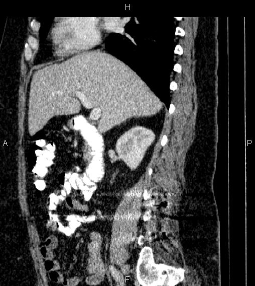 Adrenal myelolipoma (Radiopaedia 84319-99617 Sagittal renal cortical phase 35).jpg