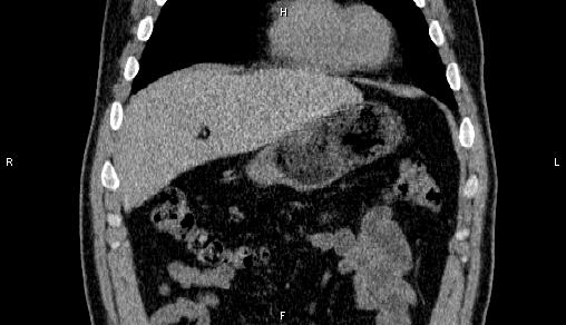 Adrenal myelolipoma (Radiopaedia 84321-99619 Coronal non-contrast 16).jpg