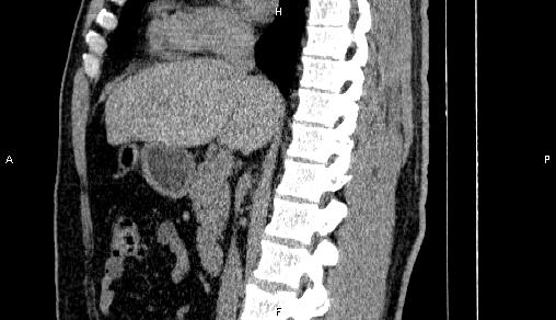 Adrenal myelolipoma (Radiopaedia 84321-99619 Sagittal non-contrast 51).jpg