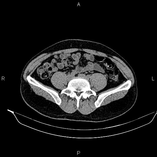 File:Adrenal myelolipoma (Radiopaedia 87794-104246 Axial non-contrast 72).jpg