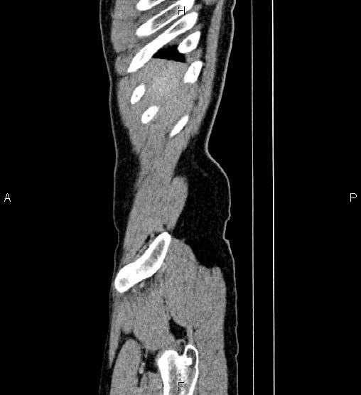 Adrenal myelolipoma (Radiopaedia 87794-104246 Sagittal renal cortical phase 3).jpg