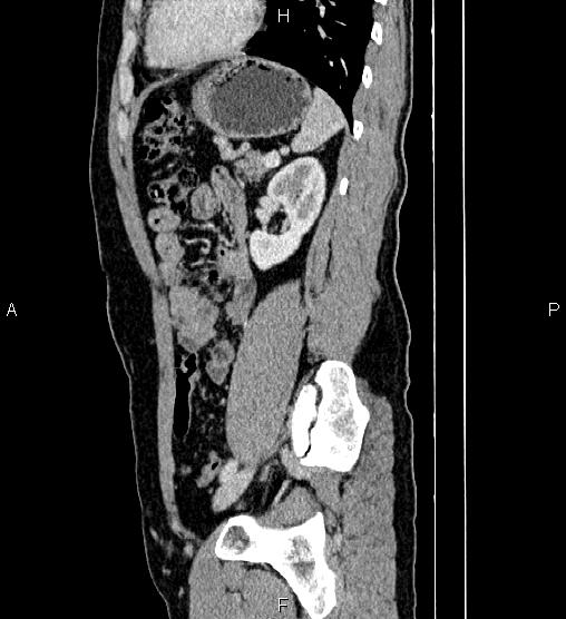 Adrenal myelolipoma (Radiopaedia 87794-104246 Sagittal renal cortical phase 66).jpg