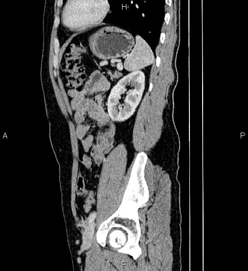 Adrenal myelolipoma (Radiopaedia 87794-104246 Sagittal renal cortical phase 70).jpg