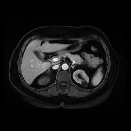 Adrenal myelolipoma - MRI (Radiopaedia 83249-97646 T1 fat sat arterial phase 33).jpg