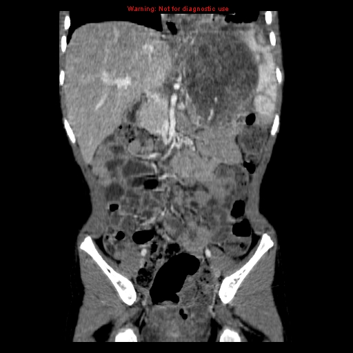 File:Adrenocortical carcinoma (Radiopaedia 9449-10131 Coronal C+ portal venous phase 6).jpg