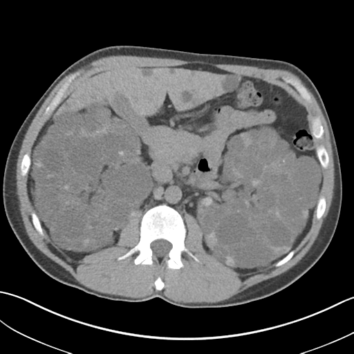 File:Adult polycystic kidney disease (Radiopaedia 47866-52626 Axial non-contrast 30).png