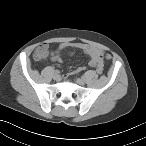 File:Adult polycystic kidney disease (Radiopaedia 47866-52626 Axial non-contrast 61).png