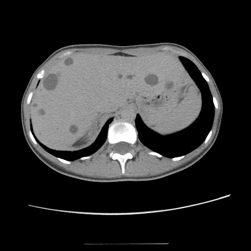 Adult polycystic kidney disease (Radiopaedia 48845-53876 Axial renal excretory phase 24).jpg