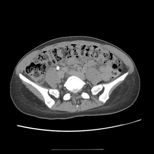 Adult polycystic kidney disease (Radiopaedia 48845-53876 Axial renal excretory phase 63).jpg