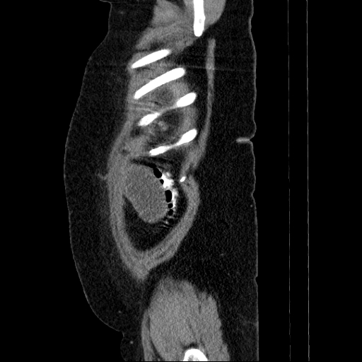 Afferent loop syndrome - secondary to incarcerated trocar site hernia (Radiopaedia 82959-97305 Sagittal C+ portal venous phase 11).jpg