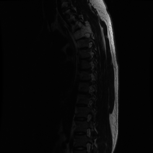 File:Aggressive vertebral hemangioma (Radiopaedia 39937-42404 Sagittal T2 5).png